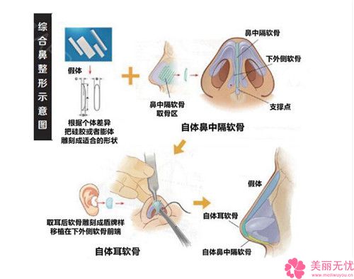 膨体聚四氟乙烯隆鼻术有没有副作用？