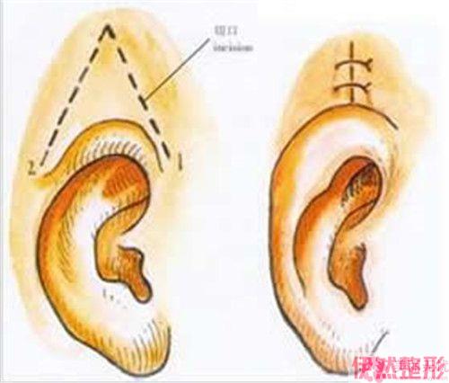 耳垂畸形矫治的常见适用症是哪些