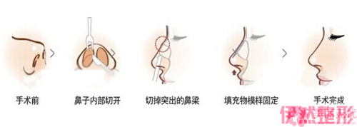 驼峰鼻先天性形成可以通过手术切除调节吗