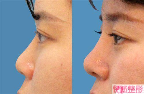 驼峰鼻先天性形成可以通过手术切除调节吗