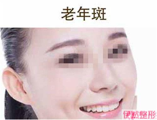 点阵激光祛痘疤都有哪些美容果？