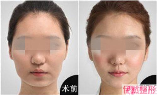 带倒钩的线实行面部埋线可维系24个月吗？