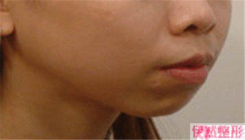 丰下颚能挑选胶原蛋白吗？