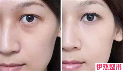 外切祛眼袋到底适合哪类人群