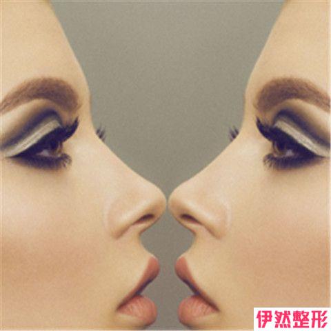 鼻头肥大整形会留疤吗