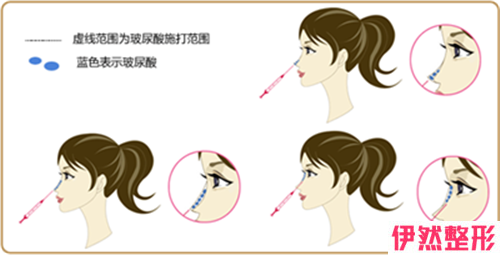 假体隆鼻手术的术后护理方式主要有哪些