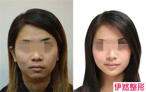 双层下巴抽脂后如何做能恢复快一点