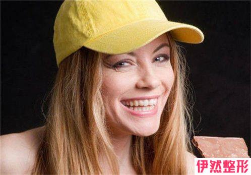 按摩祛皱纹能够消除鱼尾纹吗