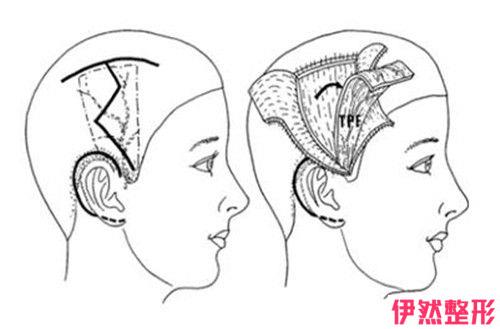 耳垂手术能恢复到之前吗