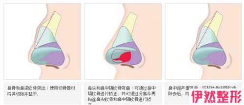 是什么导致了歪鼻子的出现，原因是什么