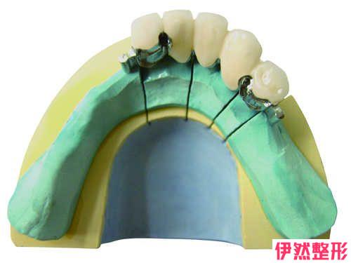 种植牙做的时候有什么优缺点