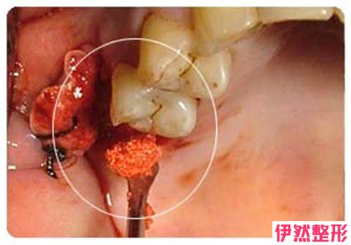 种植牙做的时候有什么优缺点