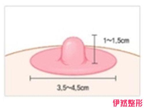 乳头凹陷修正的不良现状