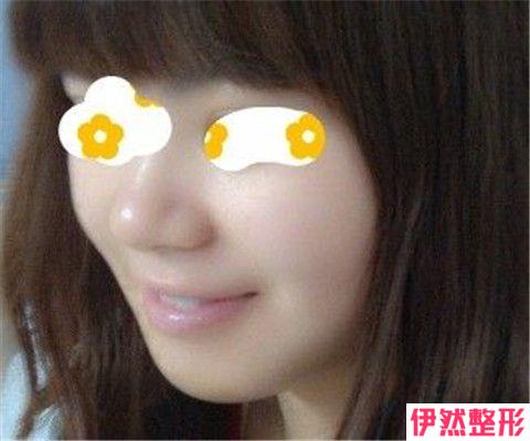 硅胶或膨体填充下巴整形的费用大概是多少