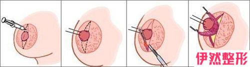 乳头内陷修正是否会产生矫正不理想？