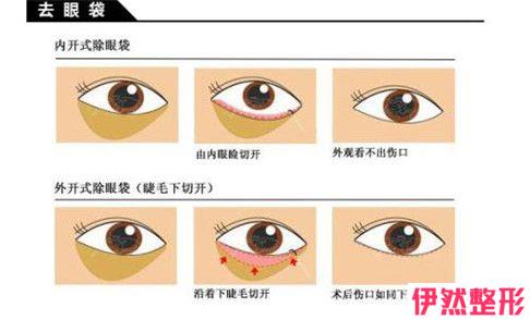 什么因素会影响皮下剥离祛眼袋的费用 