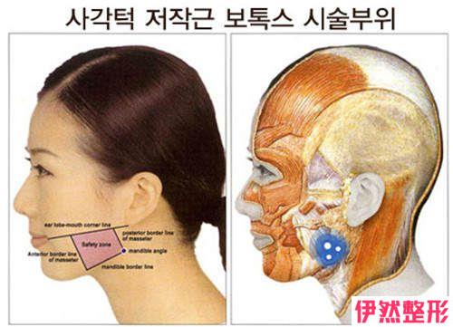 胶原物质丰下颚过后修复很迅速