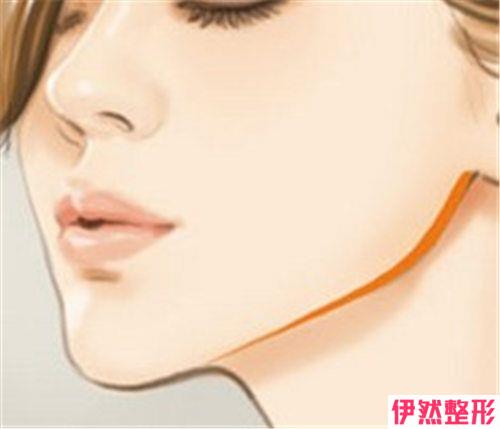 做双下巴去脂手术价格受啥因素影响