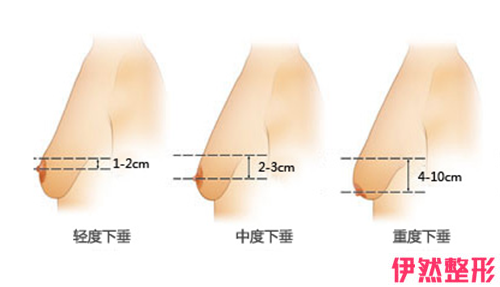 应该如何鉴别乳头内陷的严重程度