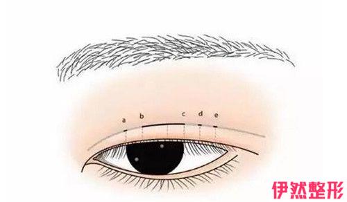 上睑下垂矫正价格介绍