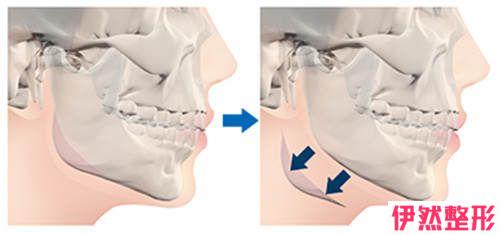 下颚注入透明质酸后可以压着手术部位吗