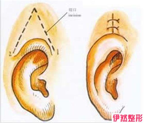 哪种耳垂缺失情况可进行手术修正 