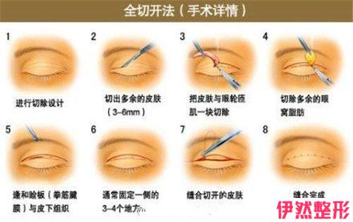 韩式三点双眼皮一般多长可实行拆线，怎样打理