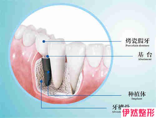 口腔种植牙的果和没问题如何