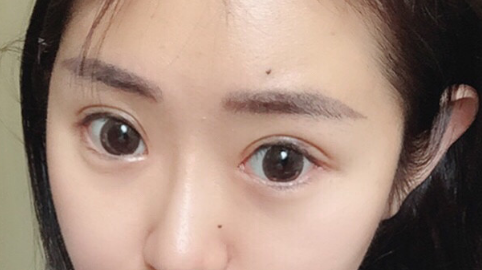 全切双眼皮几天可以碰水?全切双眼皮多久可以接眼睫毛?