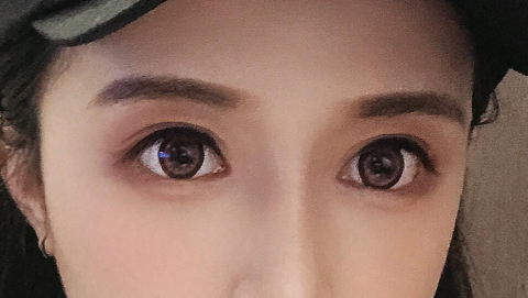 全切双眼皮会开线吗?全切双眼皮可以埋线修复吗?