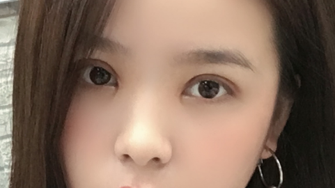 全切双眼皮可能出现的问题有哪些?全切双眼皮有硬疙瘩是怎么回事?
