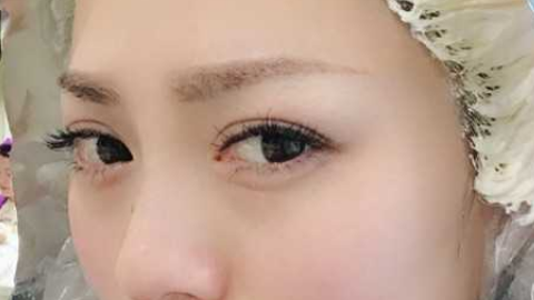 全切双眼皮可以做第二次吗?全切双眼皮需要住院吗?