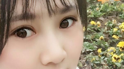 全切双眼皮可以做第二次吗?全切双眼皮需要住院吗?