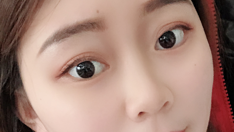全切双眼皮能做几次修复?全切双眼皮可以二次修复吗?