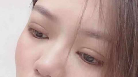 全切双眼皮能做几次修复?全切双眼皮可以二次修复吗?