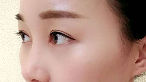 全切双眼皮是几级疼痛?全切双眼皮几天不疼?