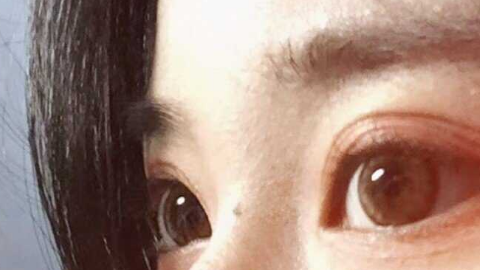 全切双眼皮是几级疼痛?全切双眼皮几天不疼?