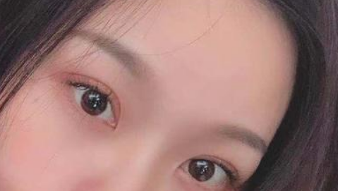 全切双眼皮是长期性的吗?全切双眼皮是不是长期的?