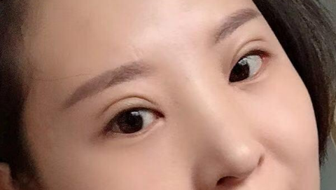 全切双眼皮是长期性的吗?全切双眼皮是不是长期的?