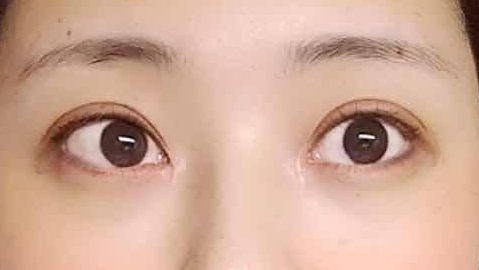 全切双眼皮是怎么弄的?全切双眼皮是切掉一块皮吗?