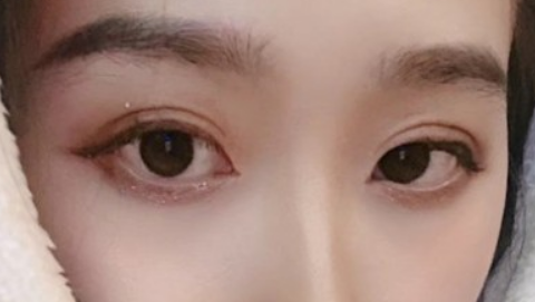 全切双眼皮是怎么弄的?全切双眼皮是切掉一块皮吗?