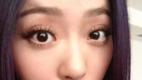 全切双眼皮需要吃消炎药吗?全切双眼皮几天可以上班?